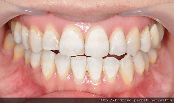 高雄/牙醫/推薦/左營/美白/植牙 高雄/牙醫/推薦/左營/美白/植牙