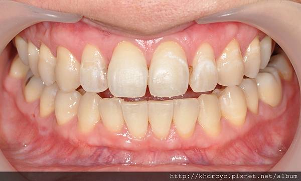 高雄/牙醫/推薦/左營/美白/植牙