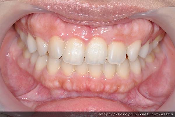 高雄牙醫/左營牙醫/牙醫推薦/高雄植牙 高雄牙醫/左營牙醫/牙醫推薦/高雄植牙