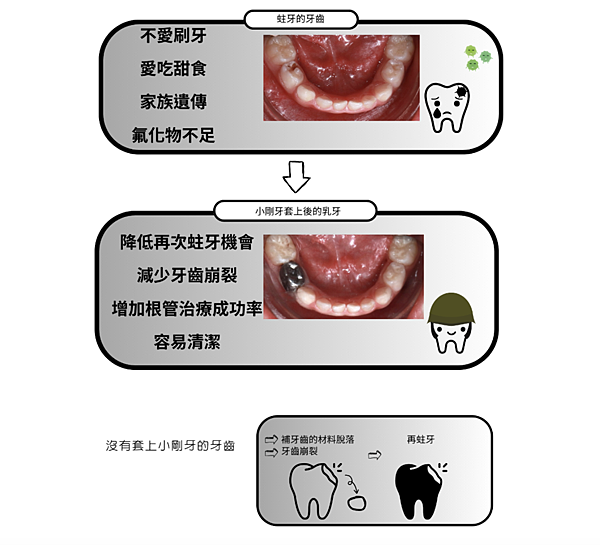 「兒童牙科」什麼是乳牙不銹鋼牙套？一定要做嗎？ 高雄牙醫推薦