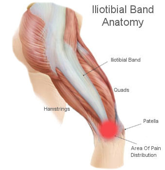 Iliotibial-Band-Syndrome.jpg