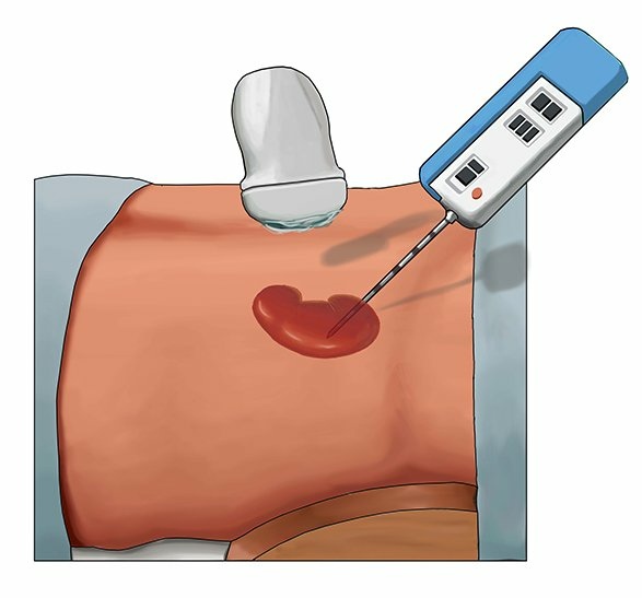 Kidney-Biopsy.jpg