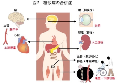 糖尿病03