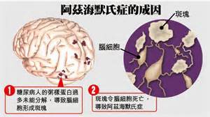 阿茲海默症 阿茲海默症