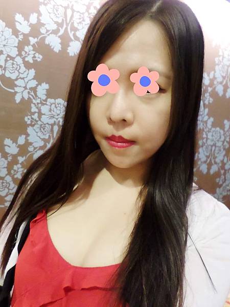 [分享]自體脂肪補臉分享