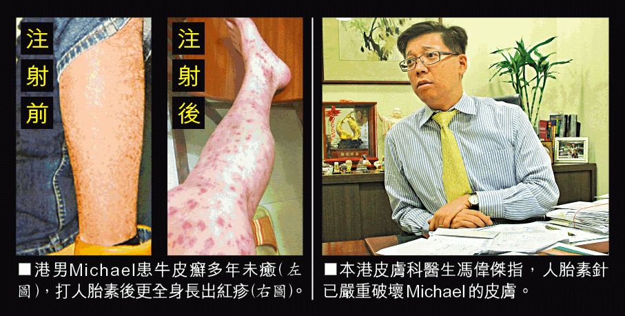 人胎素催命 港男治病出事