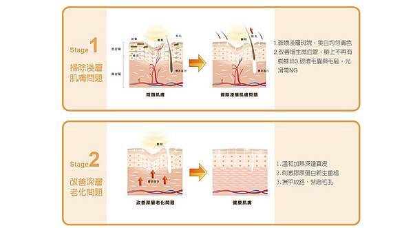 冬季除毛靚白除毛脈衝光蜜蠟除毛脫毛膏永久除毛比基尼凱蒂醫美推薦價格04.jpg