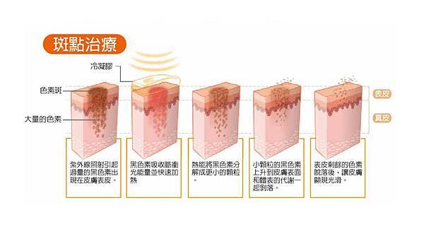 冬季除毛靚白除毛脈衝光蜜蠟除毛脫毛膏永久除毛比基尼凱蒂醫美推薦價格05.jpg