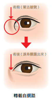 凱蒂醫美雙眼皮手術開眼頭手術切割式雙眼皮縫合式雙眼皮蒙古摺 (2)