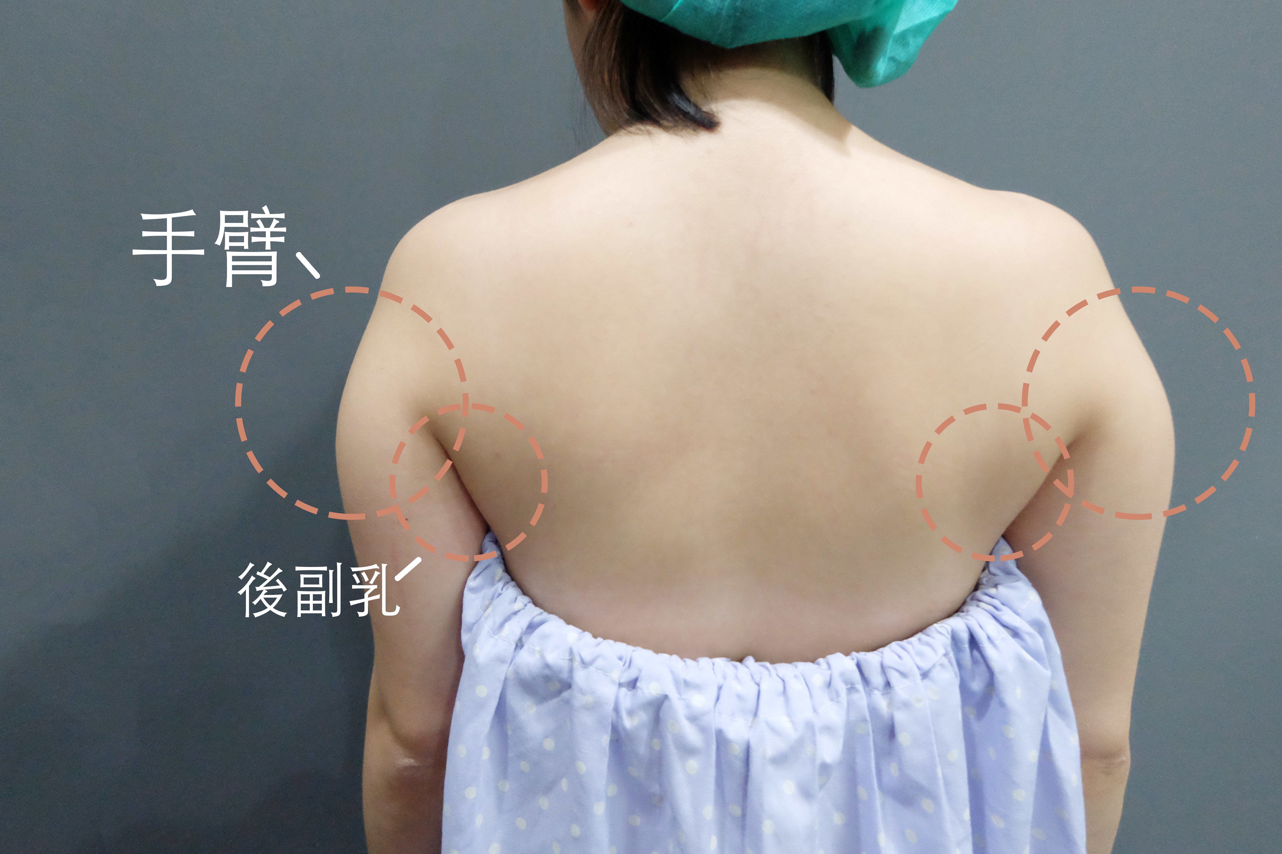 雷射減脂 蝴蝶袖 贅肉 瘦手臂 手臂