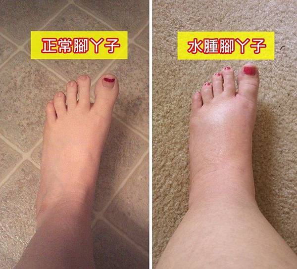 十种症状证明你缺乏蛋白质了 6 Hasil carian imej untuk æ°´è¿