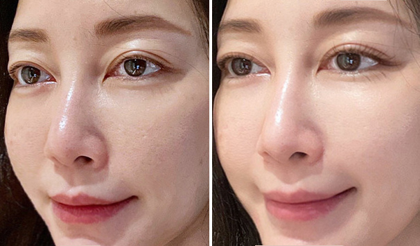 新竹杏芙診所 輕度酒糟別拖延 專業健保皮膚科 VS 醫美脈衝