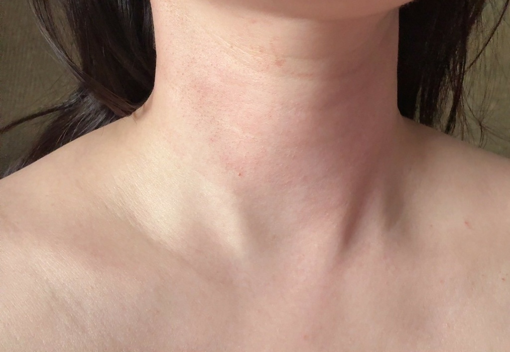 安妞美学诊所天母店 精灵水光(闪电微针+精灵真肌(聚双旋乳酸 安妞美学诊所天母店 精灵水光(闪电微针+精灵真肌(聚双旋乳酸