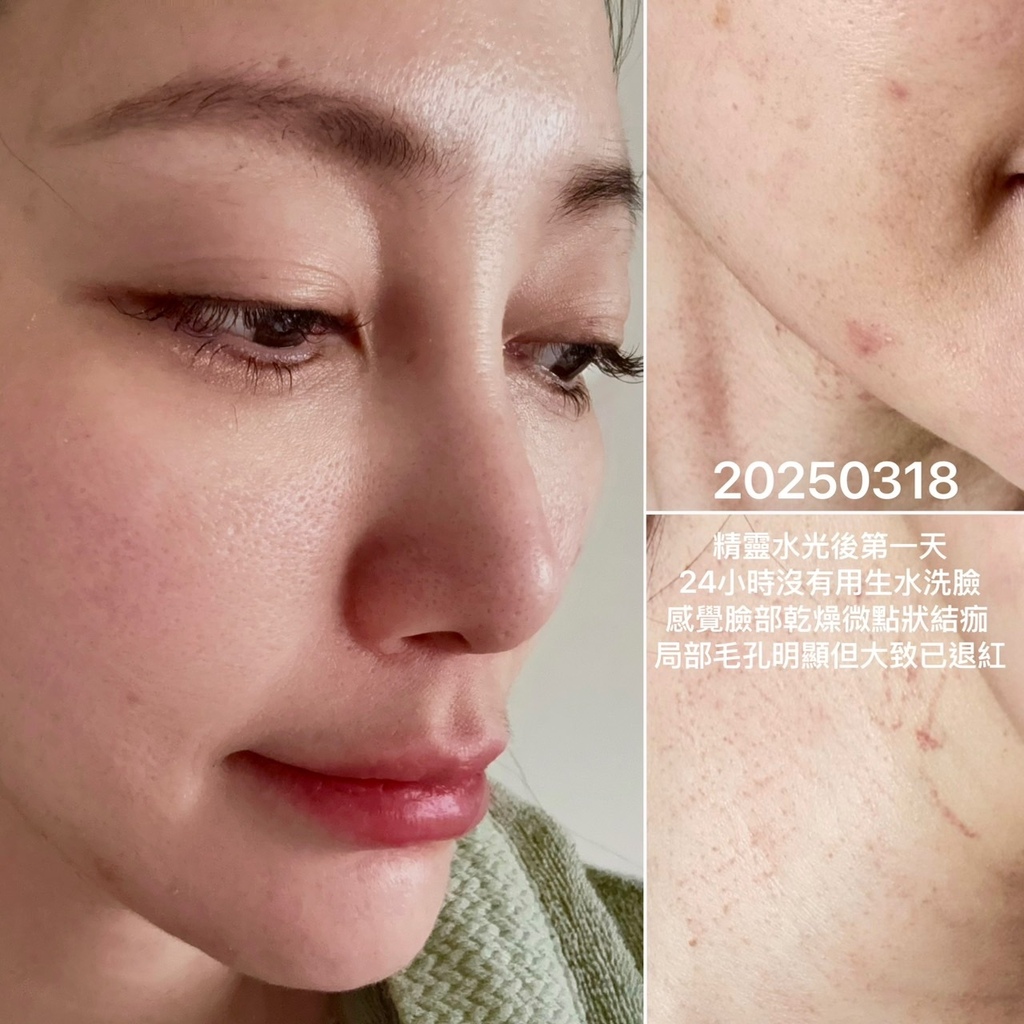 安妞美学诊所天母店 精灵水光(闪电微针+精灵真肌(聚双旋乳酸