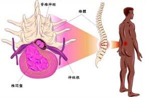 椎間盤突出? 坐骨神經痛？腰痛?(圖文)