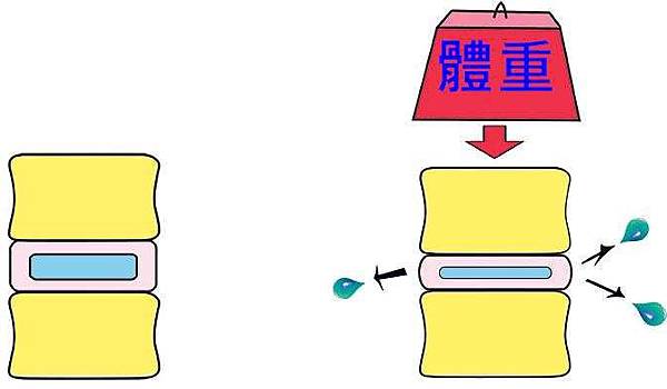 椎間盤突出? 坐骨神經痛？腰痛?(圖文)