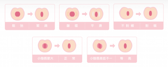 花瓣電波私密處美白私密處保養私密處黑皺萎縮乾癟陰唇鬆弛老化私密處緊實膠原蛋白私密處暗沉明亮02.png