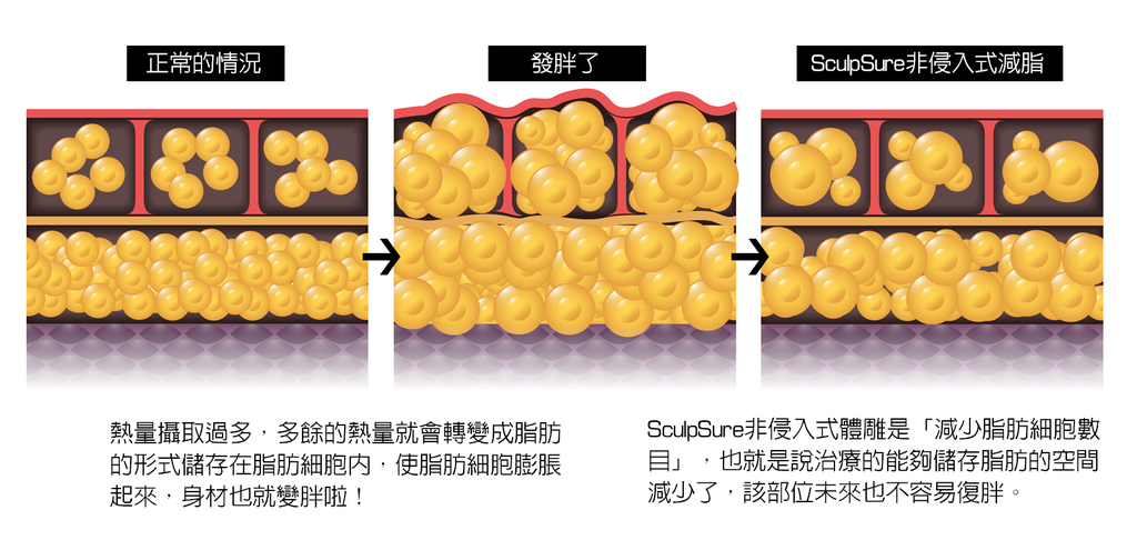 sculpsure絲酷秀體雕雷射溶脂非侵入式冷凍溶脂雷射減脂冷凍減脂8.png