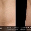 BA-SculpSure-L-Bass-1Tx-12WKs-01.jpg