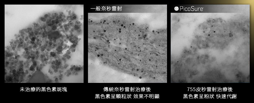 PicoSure755皮秒雷射蜂巢式聚焦陣列透鏡蜂巢透鏡皮秒雷射蜂巢皮秒雷射雀斑曬斑除斑痘疤毛孔細紋黑色素好膚質05.jpg