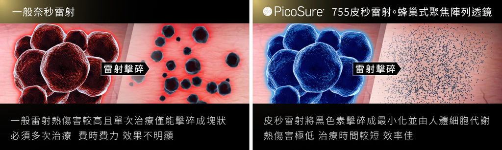 PicoSure蜂巢雷射755皮秒雷射恢復期755蜂巢皮秒雷射價格推薦機型3.jpg PicoSure蜂巢雷射755皮秒雷射恢復期755蜂巢皮秒雷射價格推薦機型3.jpg