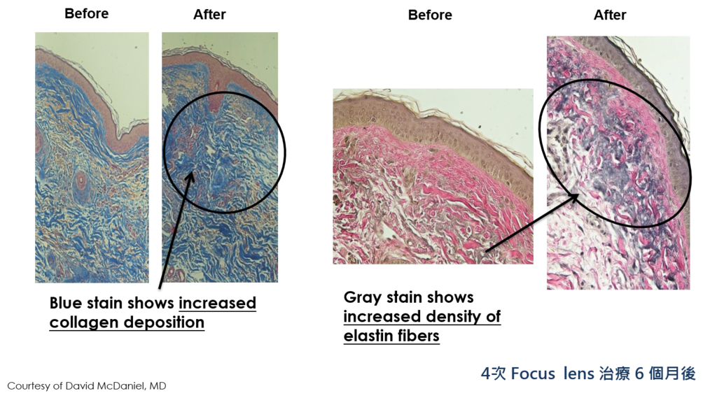 PicoSure 皮膚雷射755蜂巢皮秒雷射價格皮秒雷射多少錢皮秒雷射價格便宜雷射05.png PicoSure 皮膚雷射755蜂巢皮秒雷射價格皮秒雷射多少錢皮秒雷射價格便宜雷射05.png