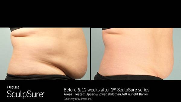 BA_SculpSure_C_Petti_Core_2tx_12wks_01.jpg