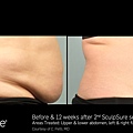 BA_SculpSure_C_Petti_Core_2tx_12wks_01.jpg