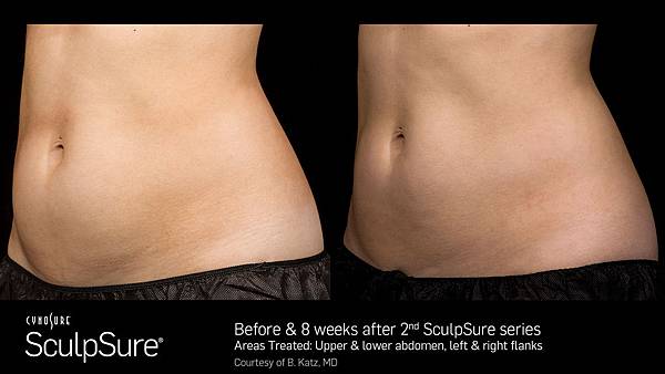 BA_SculpSure_Katz_2tx_8wks_02.jpg