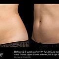 BA_SculpSure_Katz_2tx_8wks_02.jpg