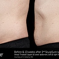 BA_SculpSure_Doherty_Abdomen_2tx_13wks_07.jpg