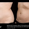 BA_SculpSure_L.Bass_Core_12wks_2 Tx_04.jpg