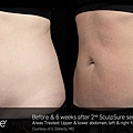 BA_SculpSure_S_Doherty_Core_2Tx_6weeks_01_19.jpg