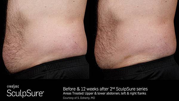 BA_SculpSure_S.Doherty_Core_2tx_12wks_01_37.jpg