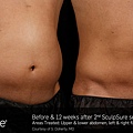 BA_SculpSure_S_Doherty_Core_2Tx_12Weeks_16.2.jpg