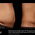 BA_SculpSure_S_Doherty_Core_2Tx_12Weeks_16.1.jpg