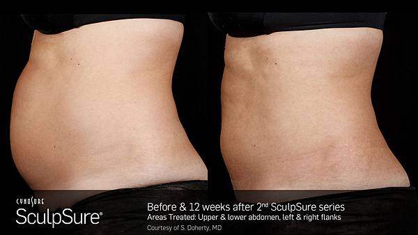 BA_SculpSure_SBS_Doherty_Core_2Tx_12Weeks_01_13.1.jpg