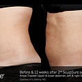 BA_SculpSure_SBS_Doherty_Core_2Tx_12Weeks_01_13.1.jpg