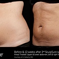 BA_SculpSure_SBS_Doherty_Core_2Tx_12Weeks_01_13.jpg