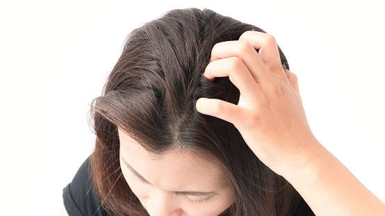 一轉凍頭皮問題出哂嚟?拆解各種頭皮問題_reference.jpg 一轉凍頭皮問題出哂嚟?拆解各種頭皮問題_reference.jpg