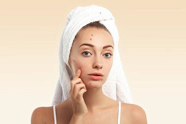 closeup-young-woman-with-towel-head-pimples-face_273609-14430.jpg