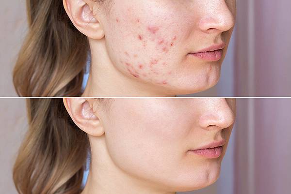 cropped-shot-young-woman-s-face-before-after-acne-treatment-face-z-PX1000.jpg