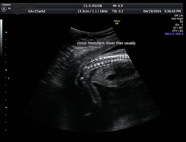 孕兒診所賴錫鉅醫師 427 什麼是高層次超音波- 檢查胎兒所