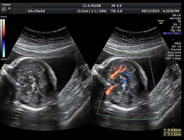 孕兒診所賴錫鉅醫師 463 胎兒腦部有疑慮需要盡快轉診 : 