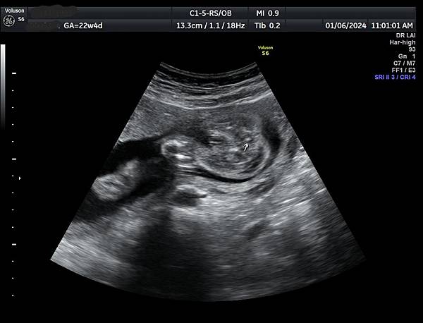 孕兒診所賴錫鉅醫師 464 低位無肛產前診斷經驗分享 - I