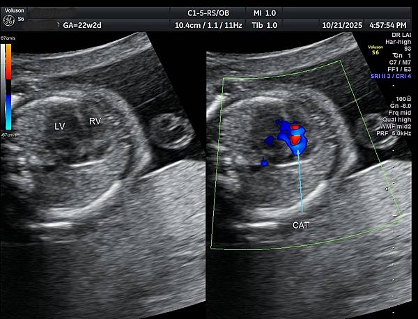 孕兒診所賴錫鉅醫師 466 產前診斷共同動脈幹經驗分享