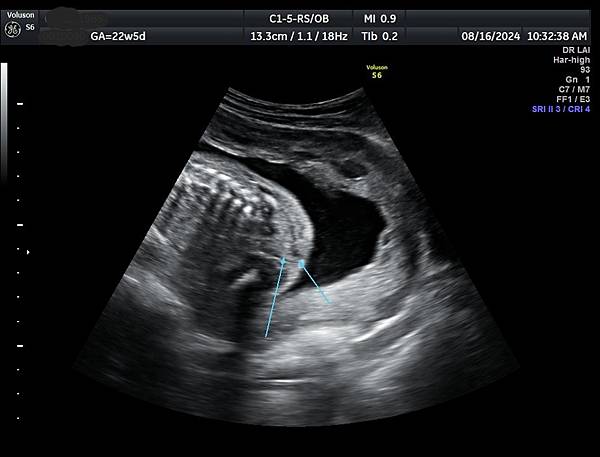 孕兒診所賴錫鉅醫師 465 低位無肛產前影像經驗分享- II