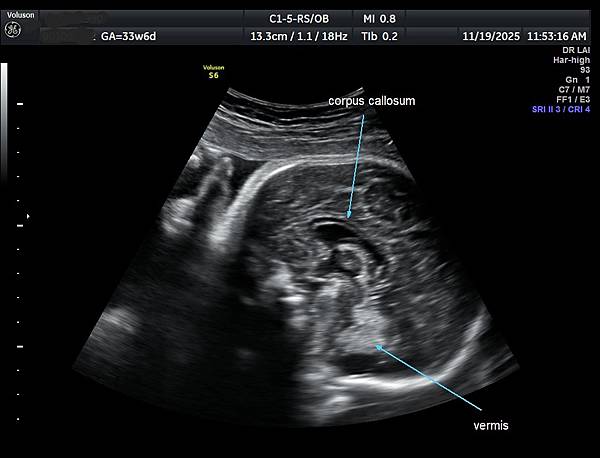 孕兒診所賴錫鉅醫師 468 小孩會走路比較重要還是照3D比較