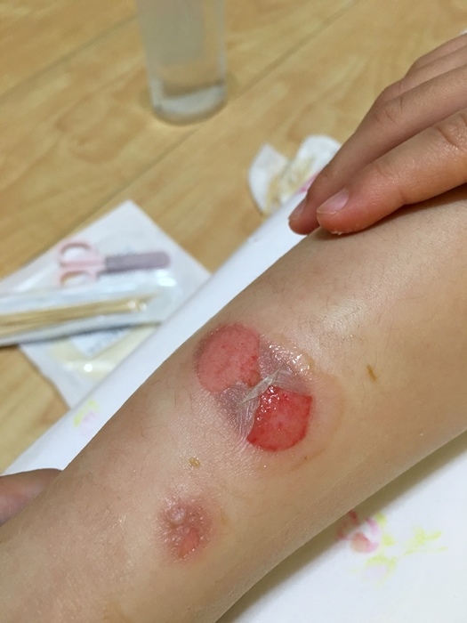 5y3m 波妞燙傷1 10天記錄 持續更新 媽咪拜mamibuy 5y3m 波妞燙傷1 10天記錄 持續更新 媽咪拜mamibuy