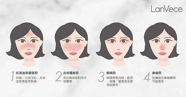 酒糟性肌膚Rosacea Skin